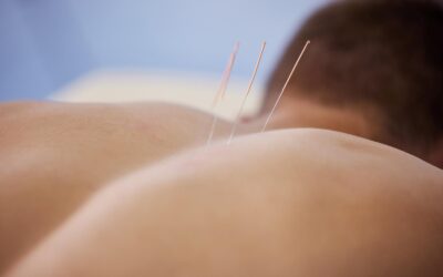 What is Neuro-Acupuncture & How Can It Help You?